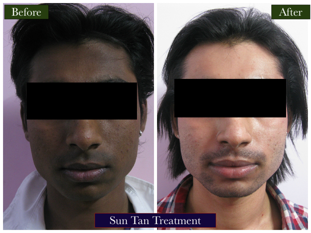 Sun Tan Treatment